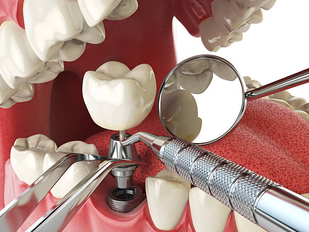 Best Broken or Cracked Tooth Emergency Dentist in Johnson City, NY