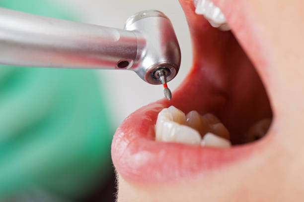 Best Emergency Dentist for Knocked-Out Tooth in Johnson City, NY